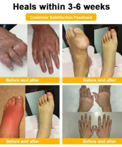 Purelora® BEE VENOM LITHOSPERMUM Pain-Relief Bone Healing Cream