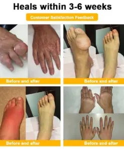 Purelora® Bee Venom Joint Repair Cream