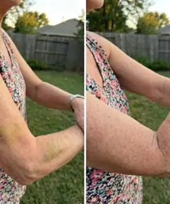 Purelora® Bruise & Visible Marks Cream
