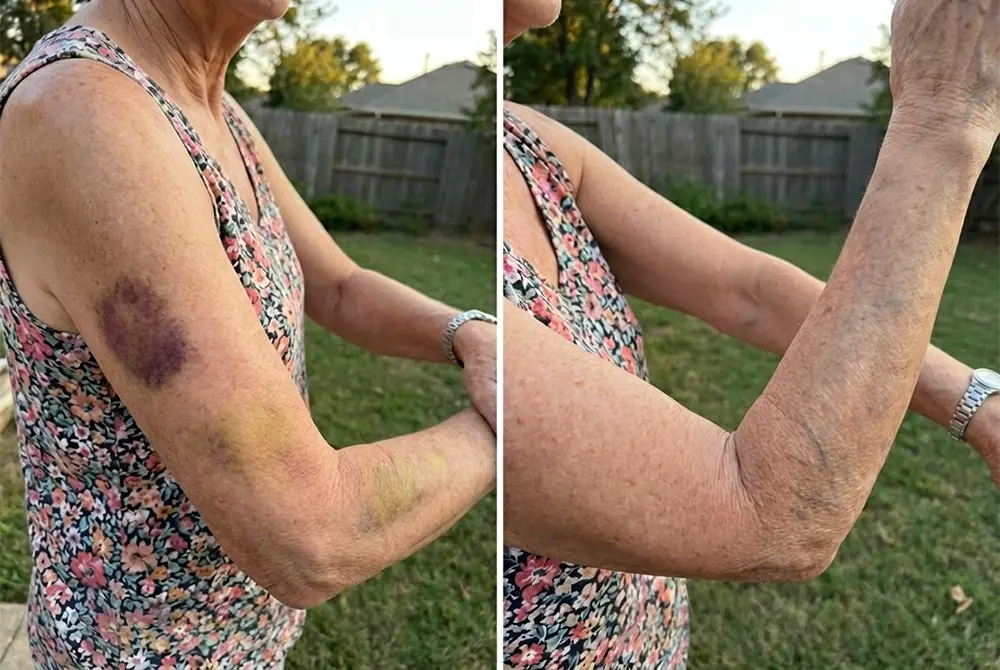 Purelora® Bruise & Visible Marks Cream
