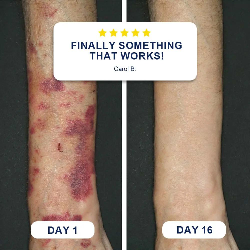 ๐๐๐๐๐๐๐๐ยฎ Bruise Repair Cream