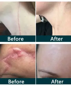 Purelora® SILICONE SCAR THERAPY ROLL