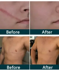 Purelora® SILICONE SCAR THERAPY ROLL