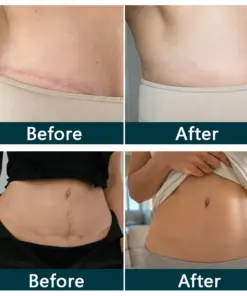 Purelora® SILICONE SCAR THERAPY ROLL